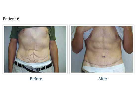 male tummy tuck before and after