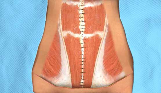 tummy tuck procedure